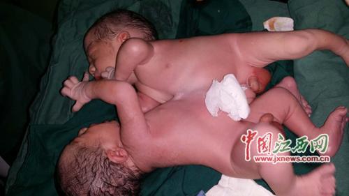 中国で連体双子 母親は１８歳の女性 中国通